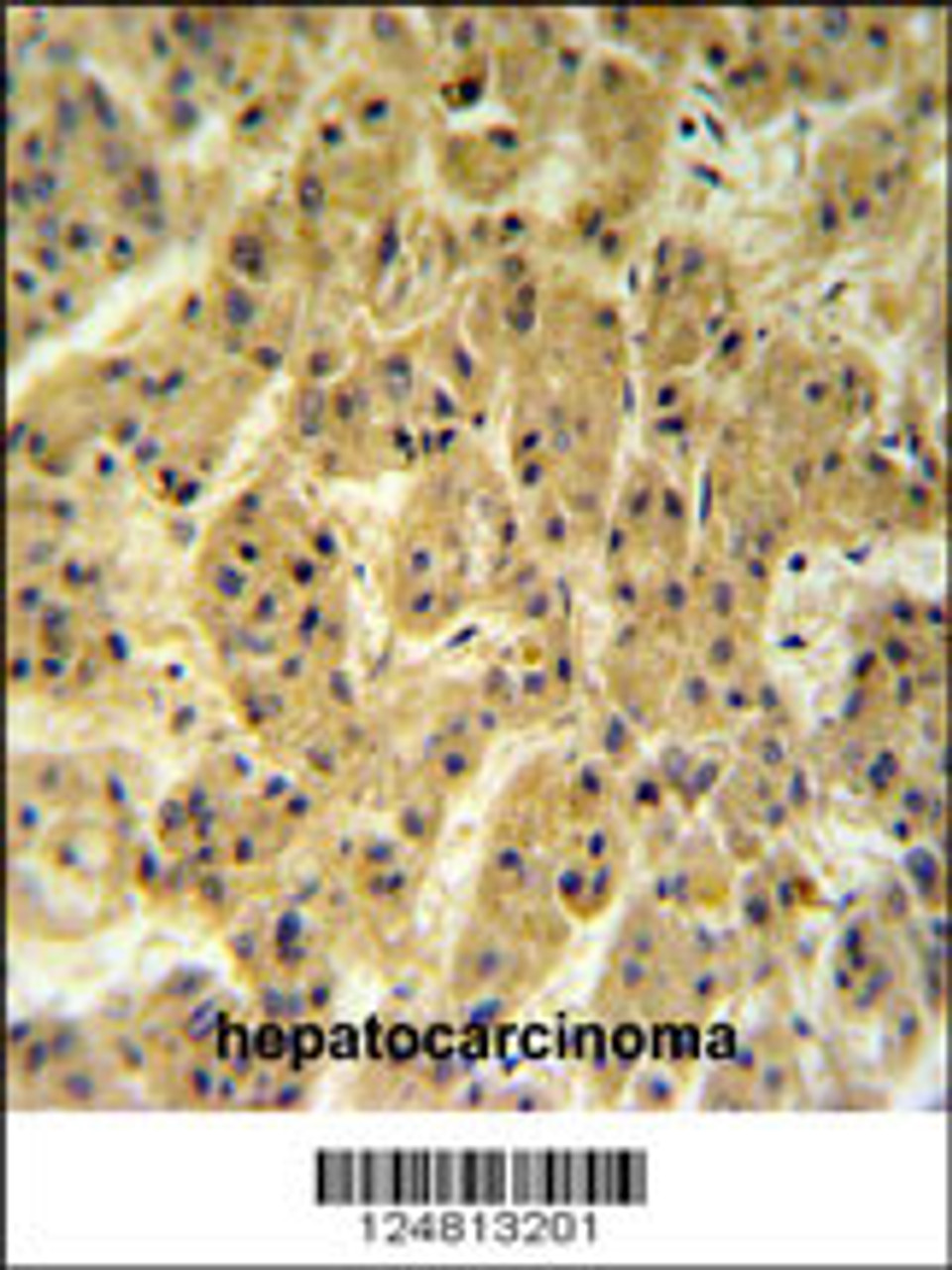 SC24A Antibody IHC analysis in formalin fixed and paraffin embedded hepatocarcinoma followed by peroxidase conjugation of the secondary antibody and DAB staining.