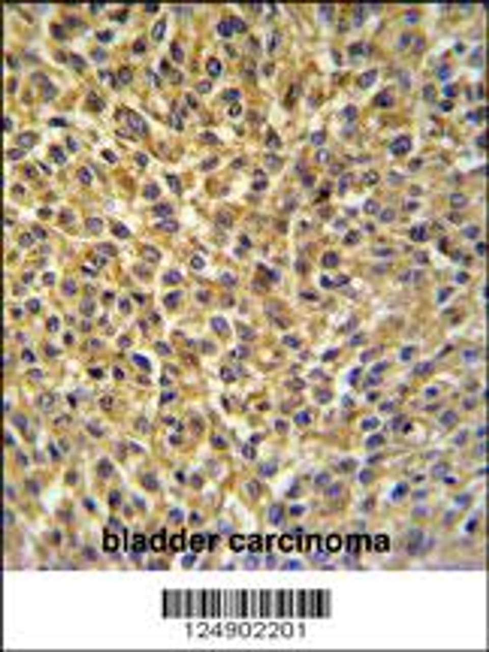 CRIP1 Antibody IHC analysis in formalin fixed and paraffin embedded bladder carcinoma followed by peroxidase conjugation of the secondary antibody and DAB staining.