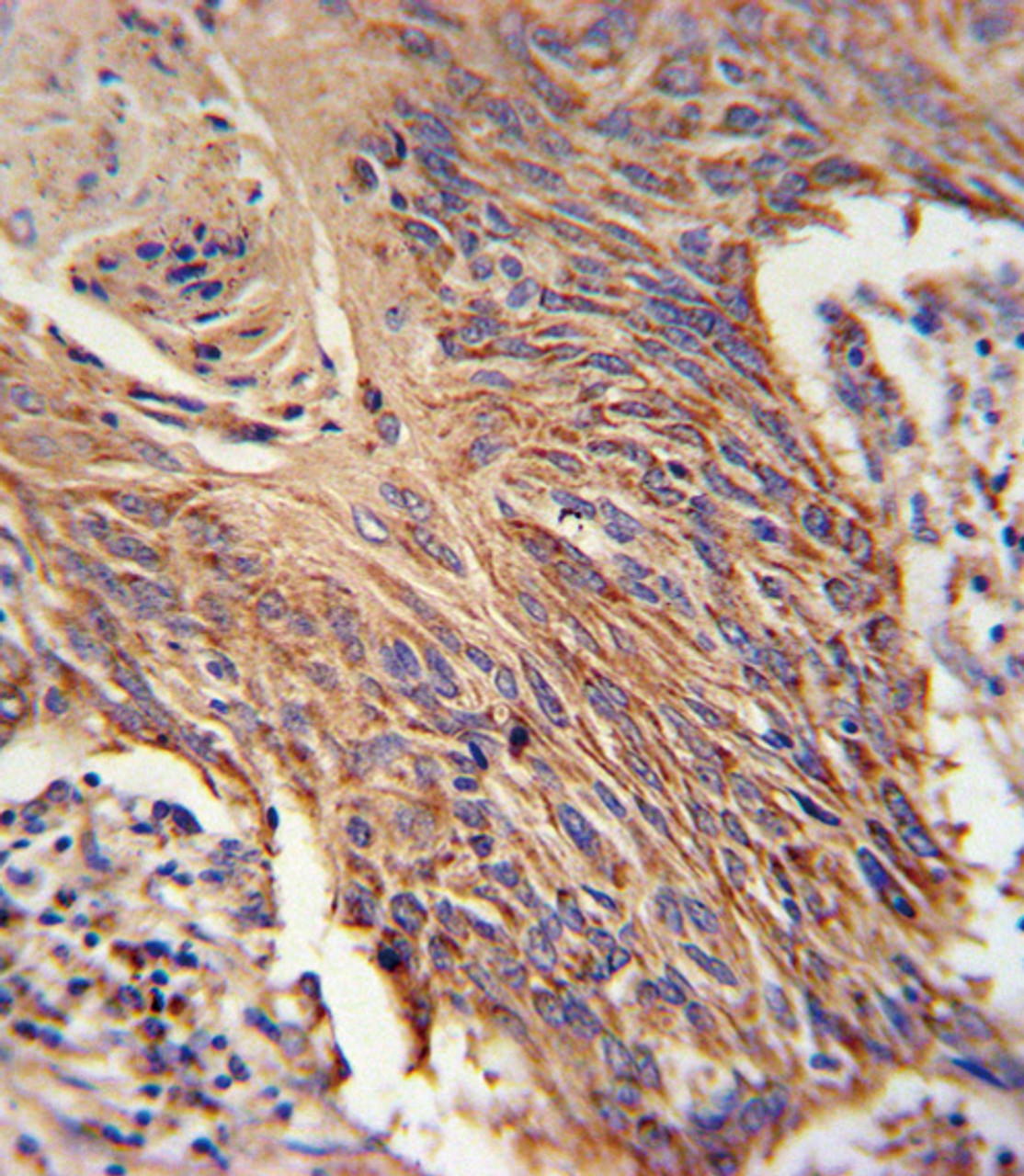 RDH10 Antibody immunohistochemistry analysis in formalin fixed and paraffin embedded lung carcinoma followed by peroxidase conjugation of the secondary antibody and DAB staining.