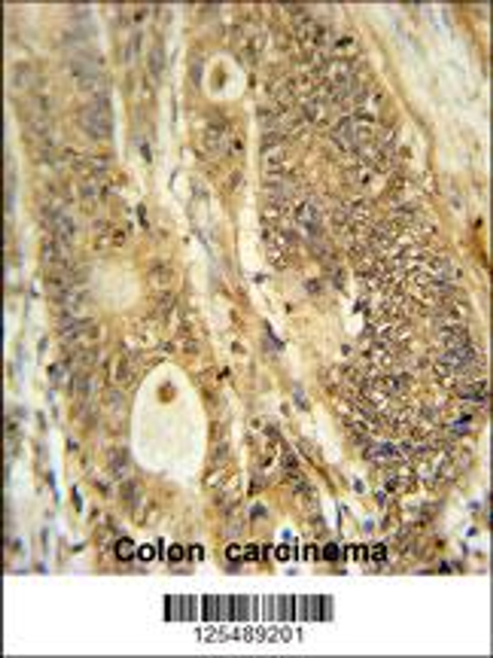 AVIL Antibody immunohistochemistry analysis in formalin fixed and paraffin embedded human colon carcinoma followed by peroxidase conjugation of the secondary antibody and DAB staining.