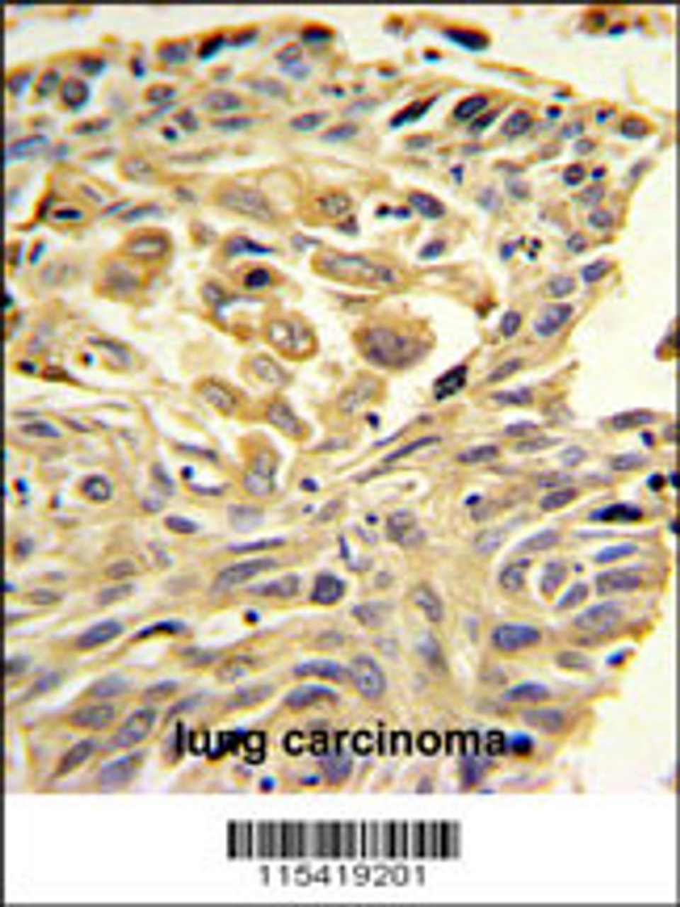 ZO1 Antibody IHC analysis in formalin fixed and paraffin embedded lung carcinoma followed by peroxidase conjugation of the secondary antibody and DAB staining.
