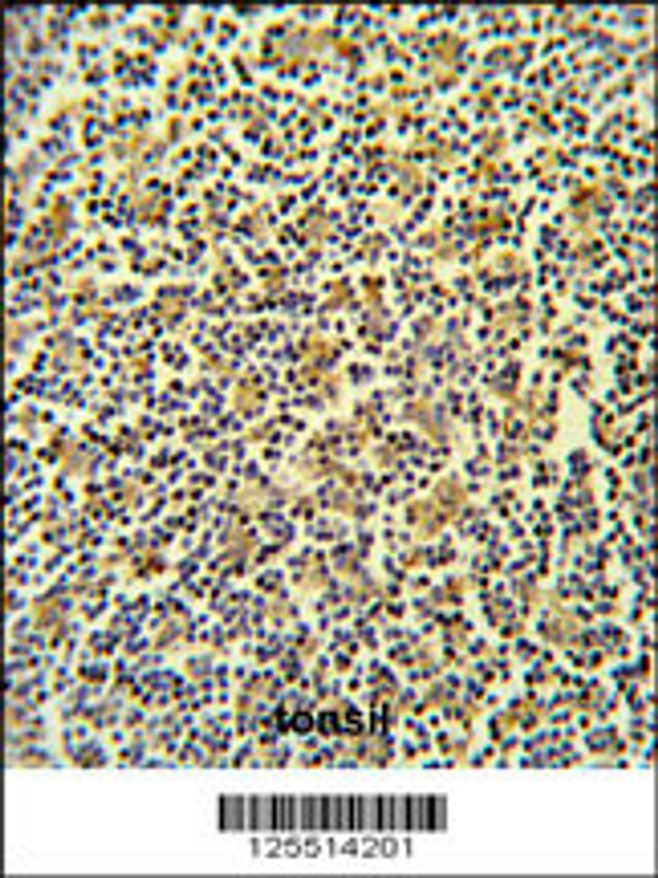 CORO6 Antibody IHC analysis in formalin fixed and paraffin embedded lymph carcinoma followed by peroxidase conjugation of the secondary antibody and DAB staining.