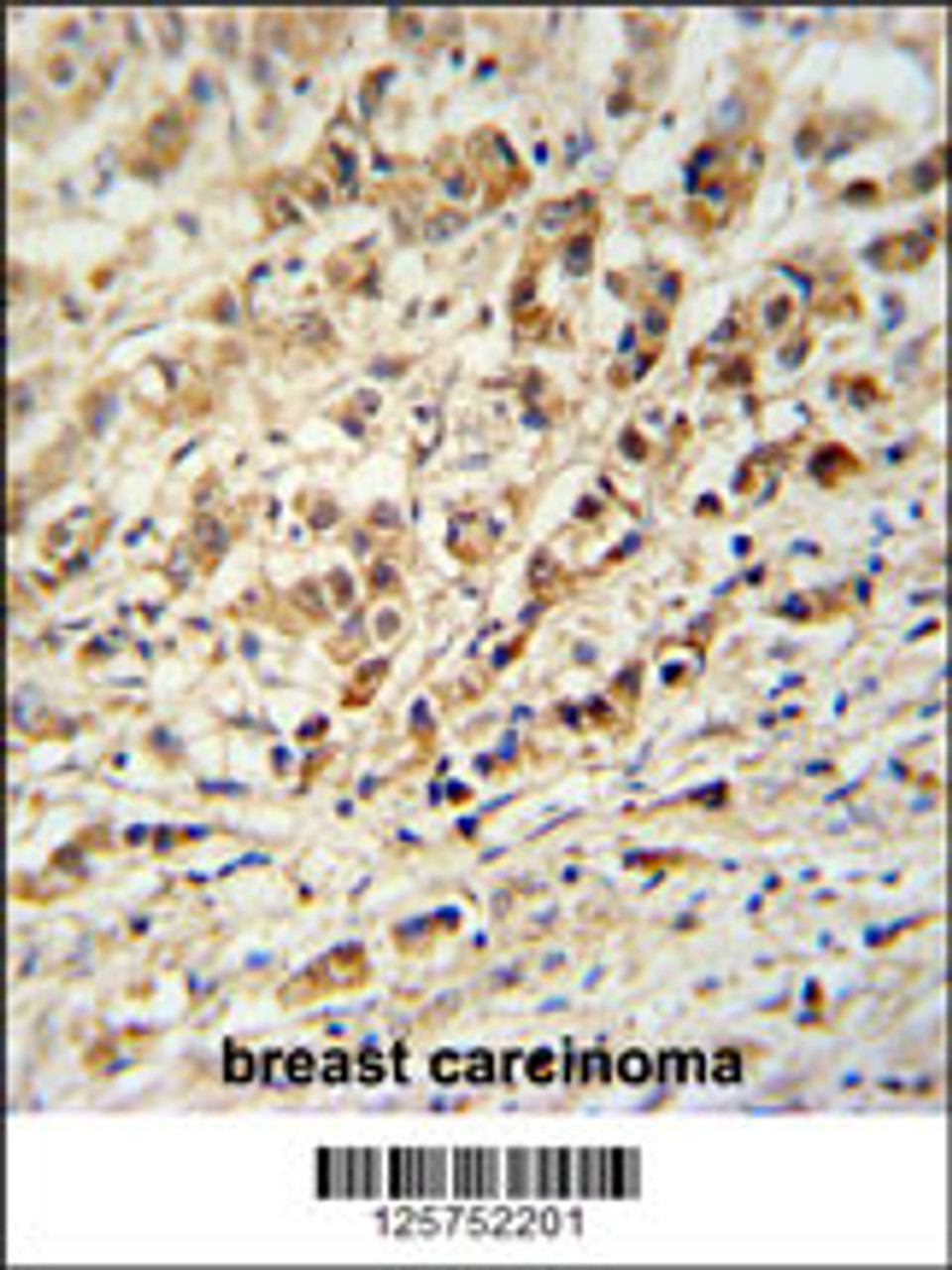 AVL9 Antibody immunohistochemistry analysis in formalin fixed and paraffin embedded human breast carcinoma followed by peroxidase conjugation of the secondary antibody and DAB staining.