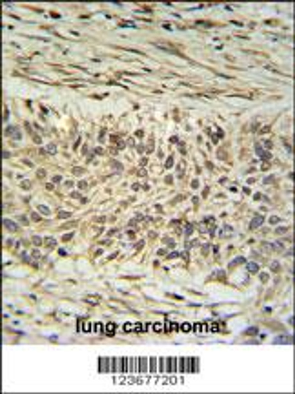 DDX23 Antibody IHC analysis in formalin fixed and paraffin embedded lung carcinoma followed by peroxidase conjugation of the secondary antibody and DAB staining.