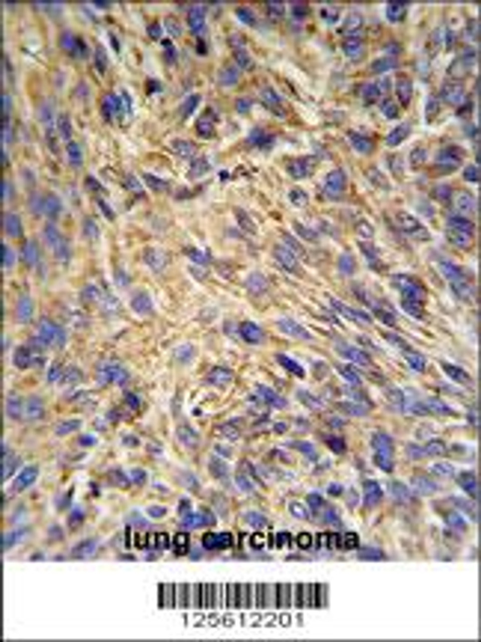 HSP90B1 Antibody IHC analysis in formalin fixed and paraffin embedded human lung carcinoma followed by peroxidase conjugation of the secondary antibody and DAB staining.