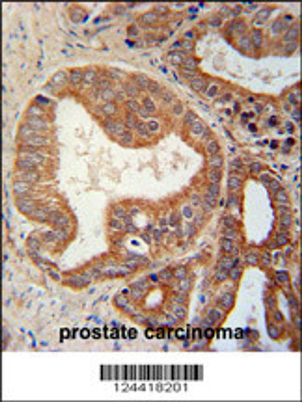CSGALNACT1 Antibody immunohistochemistry analysis in formalin fixed and paraffin embedded human prostate carcinoma followed by peroxidase conjugation of the secondary antibody and DAB staining.
