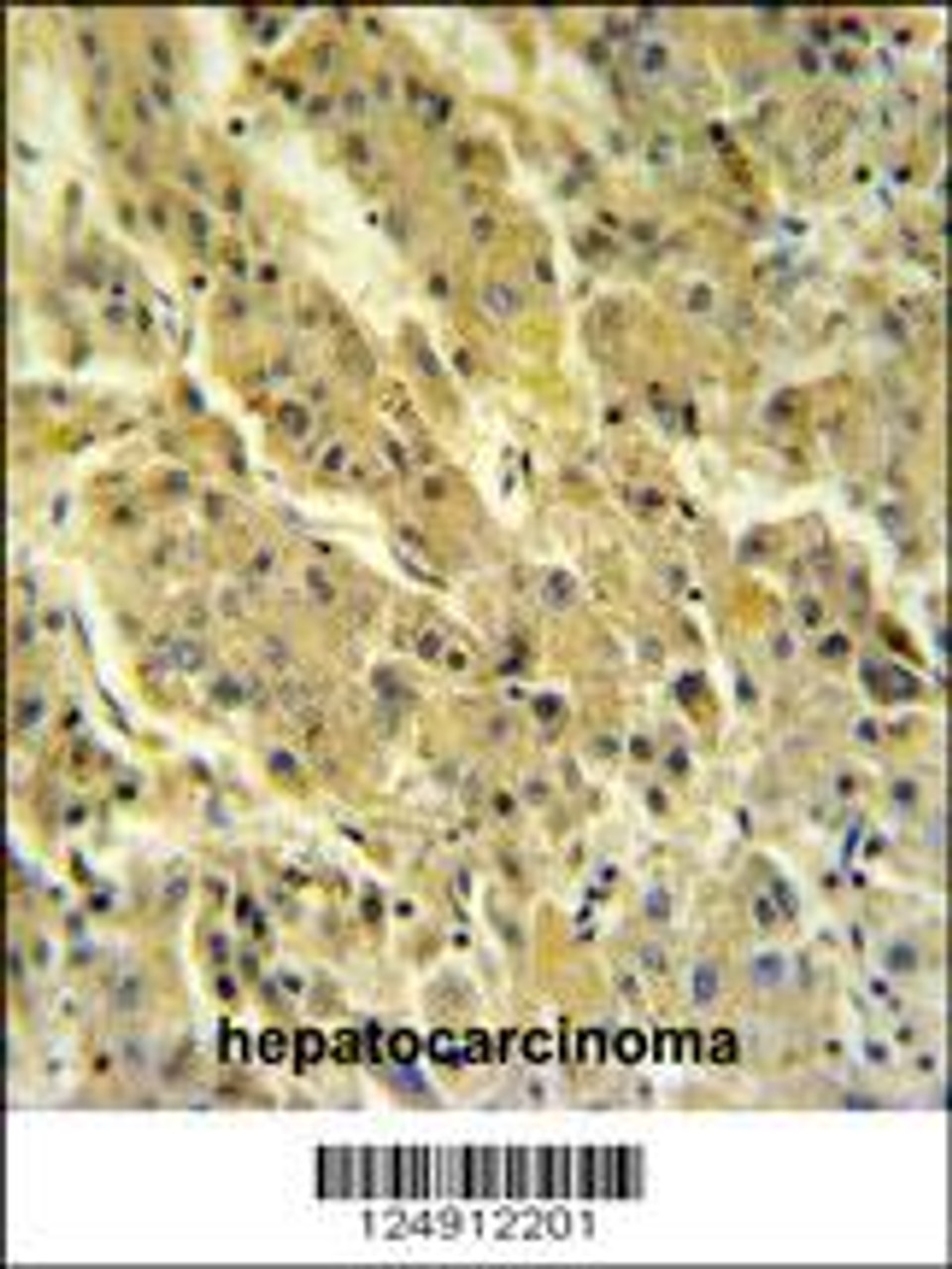 PSG7 Antibody IHC analysis in formalin fixed and paraffin embedded hepatocarcinoma followed by peroxidase conjugation of the secondary antibody and DAB staining.