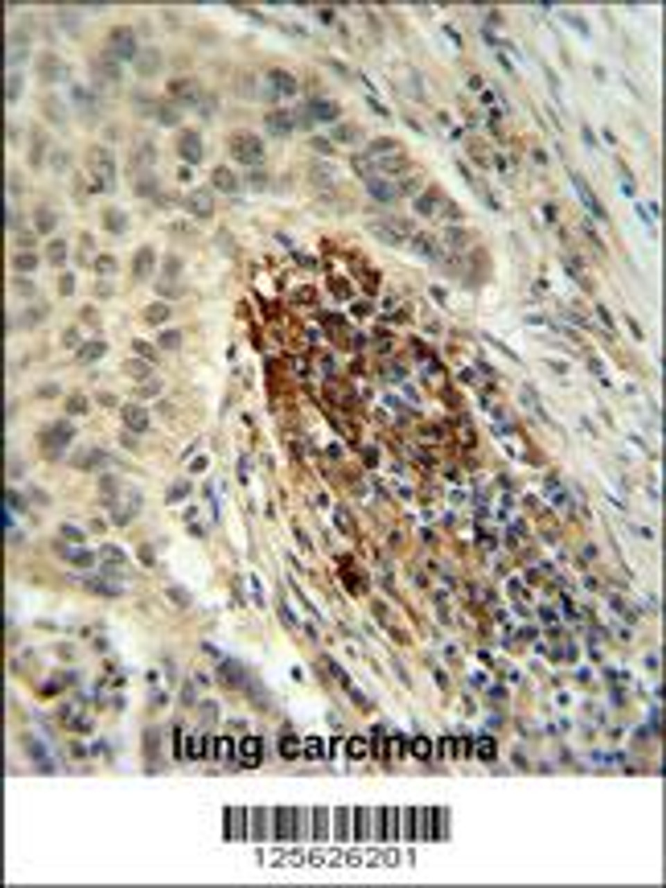 MFAP4 Antibody IHC analysis in formalin fixed and paraffin embedded human lung carcinoma followed by peroxidase conjugation of the secondary antibody and DAB staining.