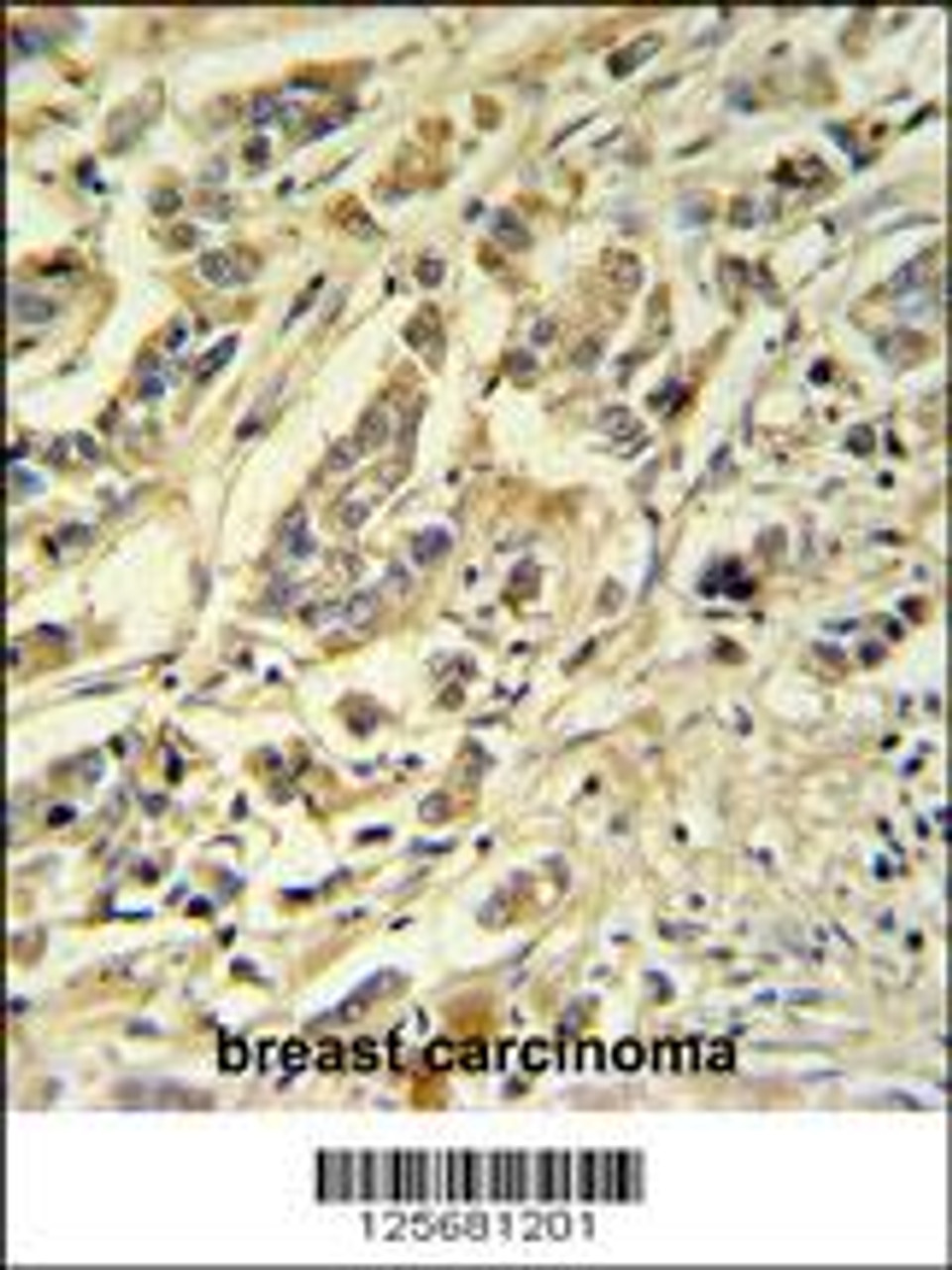 ASM3A Antibody IHC analysis in formalin fixed and paraffin embedded breast carcinoma followed by peroxidase conjugation of the secondary antibody and DAB staining.