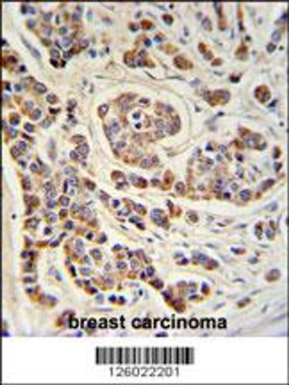 ATHL1 Antibody IHC analysis in formalin fixed and paraffin embedded human breast carcinoma followed by peroxidase conjugation of the secondary antibody and DAB staining.