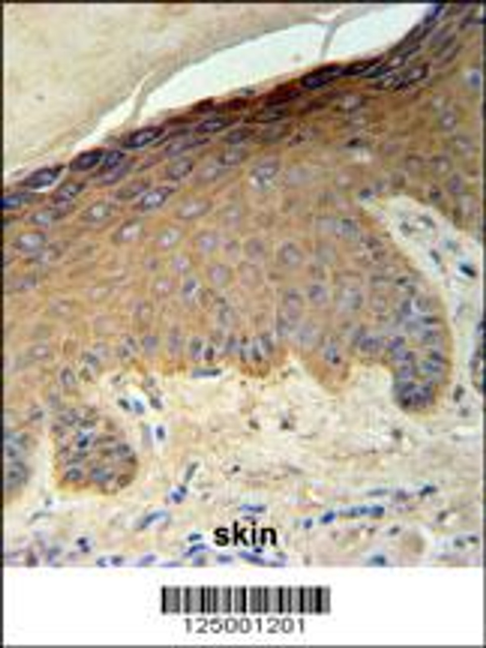 KRT35 Antibody IHC analysis in formalin fixed and paraffin embedded skin carcinoma followed by peroxidase conjugation of the secondary antibody and DAB staining.