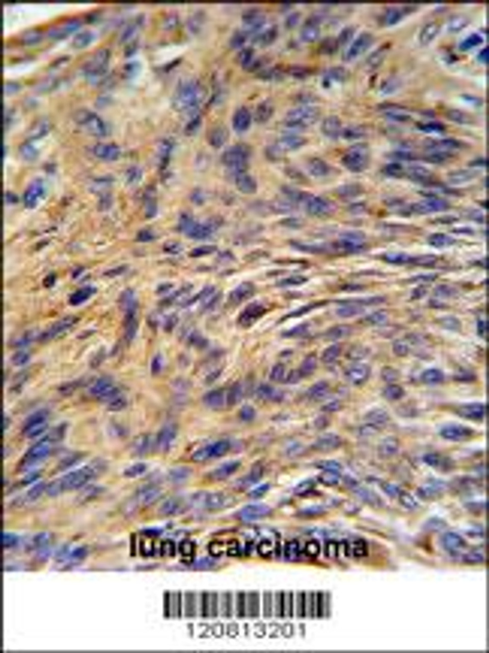 HSPA5 Antibody IHC analysis in formalin fixed and paraffin embedded human lung carcinoma followed by peroxidase conjugation of the secondary antibody and DAB staining.