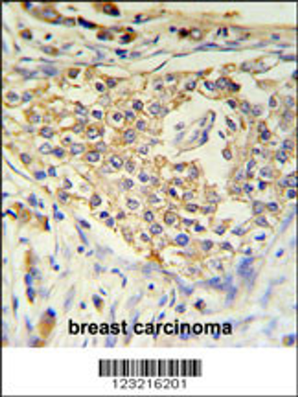 ADFP Antibody IHC analysis in formalin fixed and paraffin embedded breast carcinoma followed by peroxidase conjugation of the secondary antibody and DAB staining.