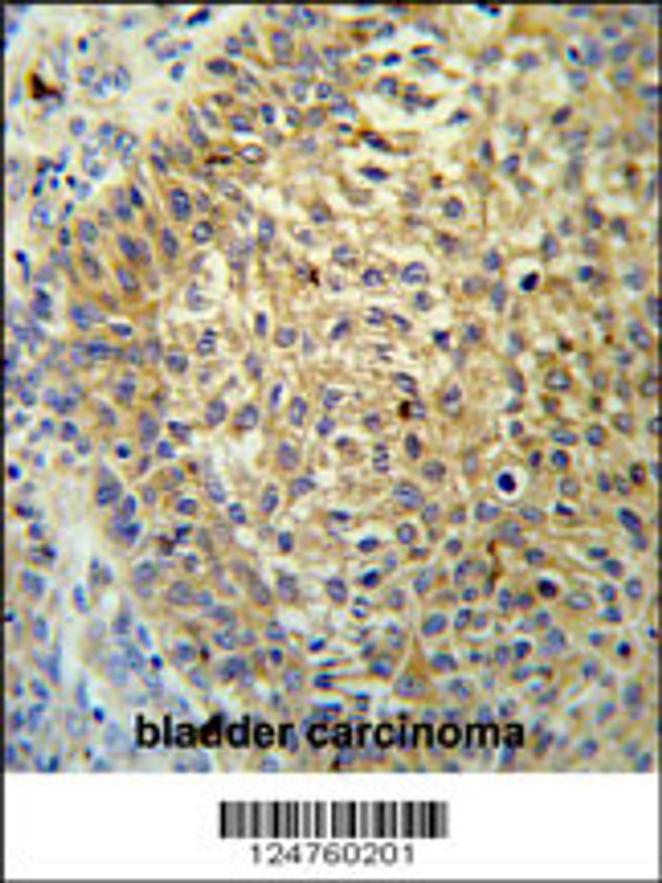 TM222 Antibody IHC analysis in formalin fixed and paraffin embedded bladder carcinoma followed by peroxidase conjugation of the secondary antibody and DAB staining.