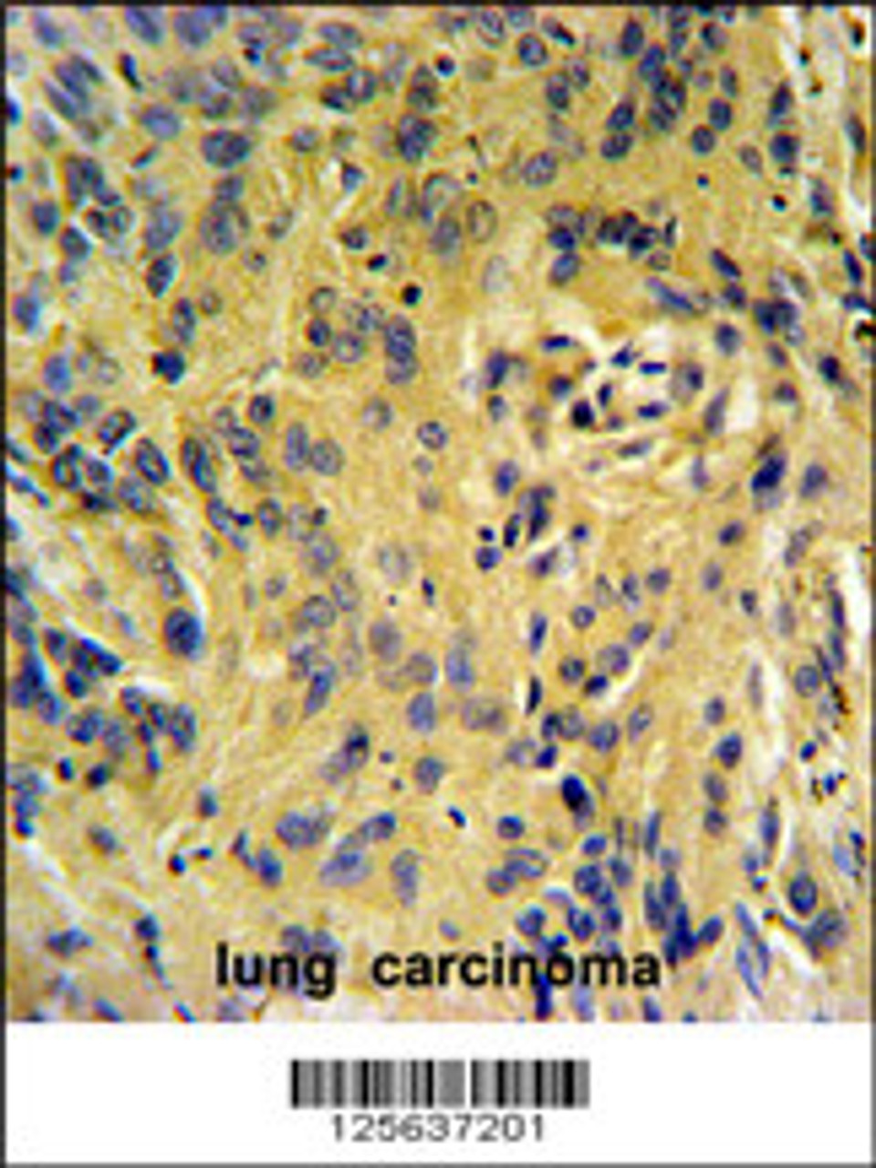 TESC Antibody IHC analysis in formalin fixed and paraffin embedded human lung carcinoma followed by peroxidase conjugation of the secondary antibody and DAB staining.