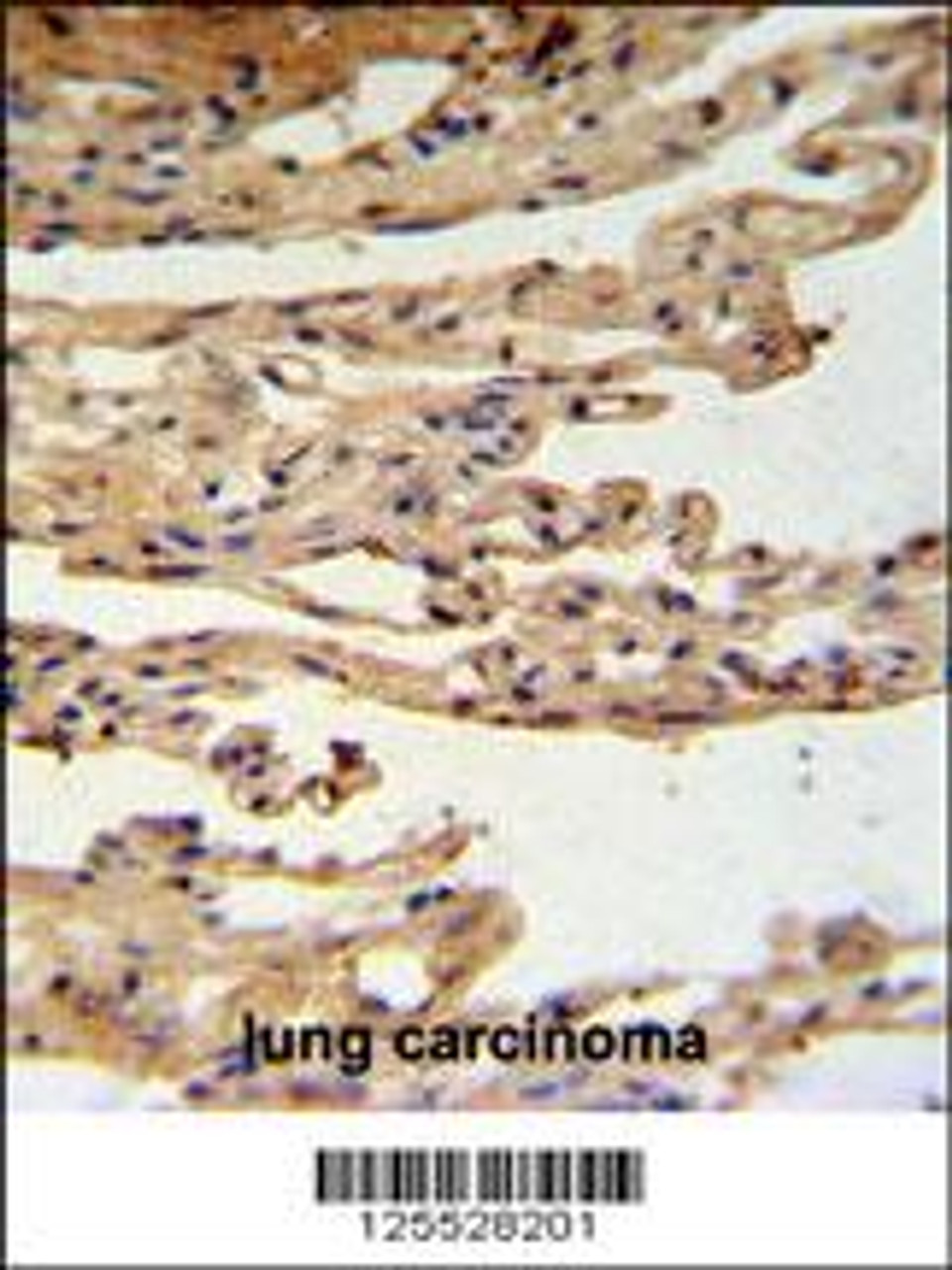 FKBPL Antibody IHC analysis in formalin fixed and paraffin embedded lung carcinoma followed by peroxidase conjugation of the secondary antibody and DAB staining.