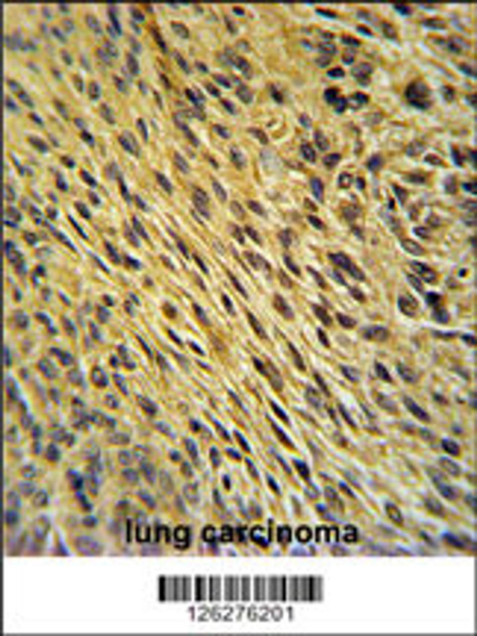 CCDC62 Antibody immunohistochemistry analysis in formalin fixed and paraffin embedded human lung carcinoma followed by peroxidase conjugation of the secondary antibody and DAB staining.