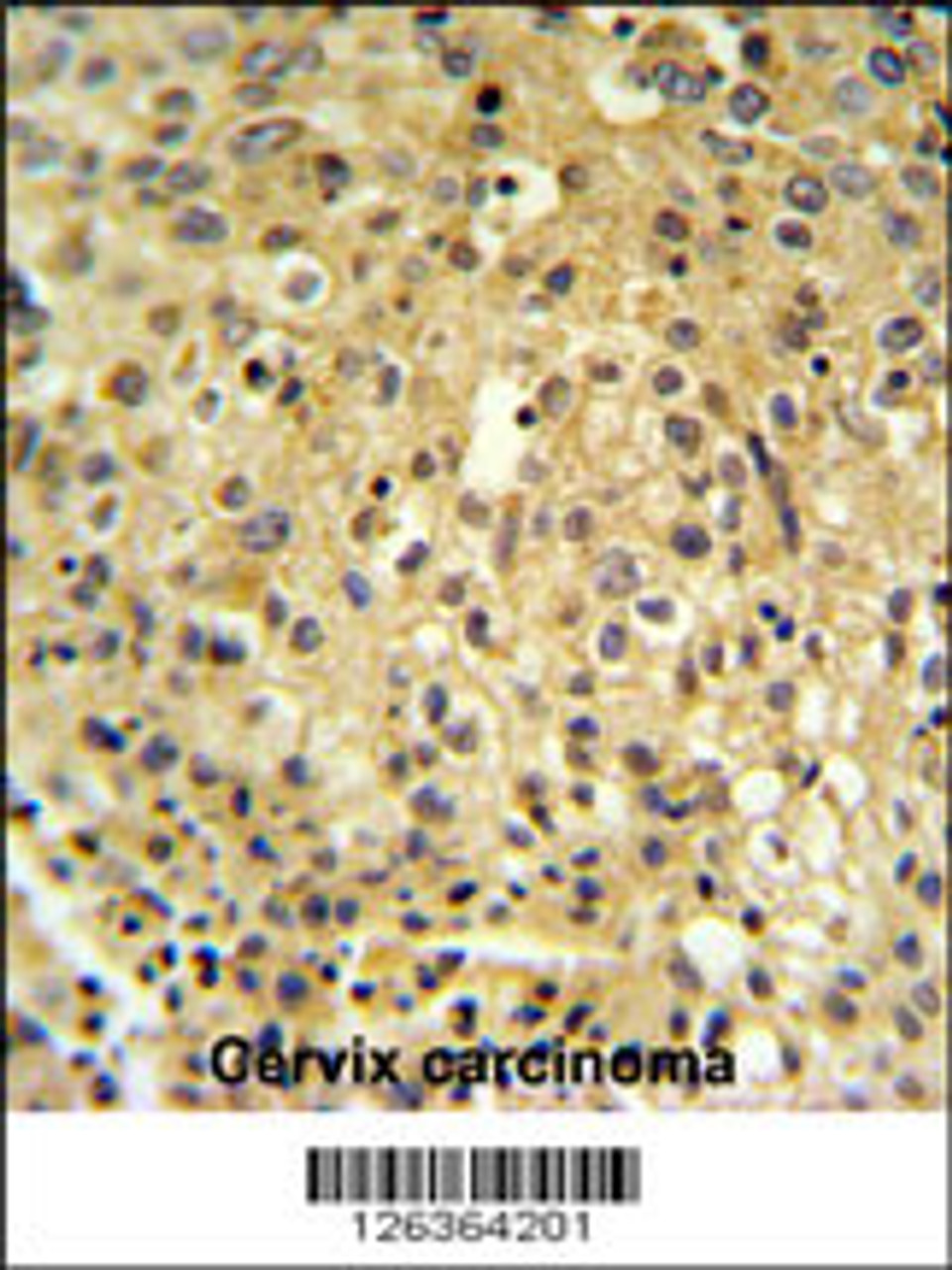 FYTD1 Antibody IHC analysis in formalin fixed and paraffin embedded human cervix carcinoma followed by peroxidase conjugation of the secondary antibody and DAB staining.