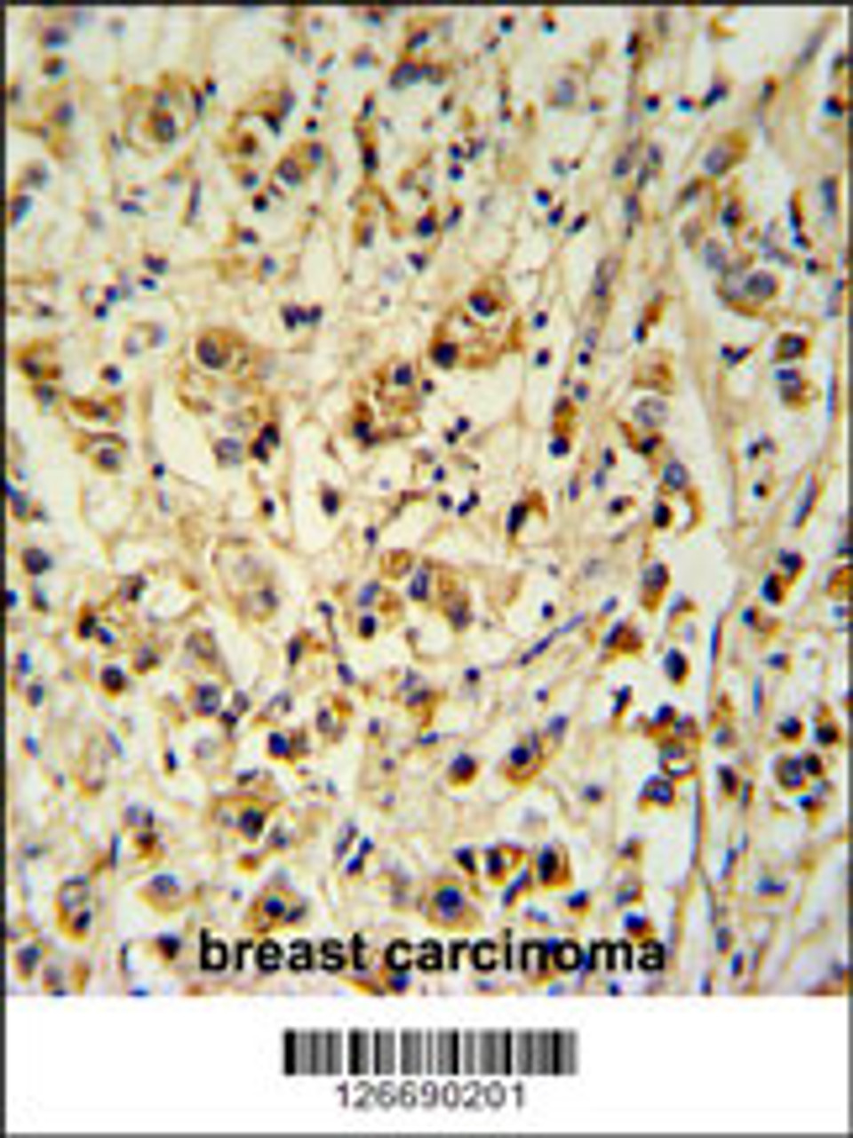SMAGP Antibody immunohistochemistry analysis in formalin fixed and paraffin embedded human breast carcinoma followed by peroxidase conjugation of the secondary antibody and DAB staining.