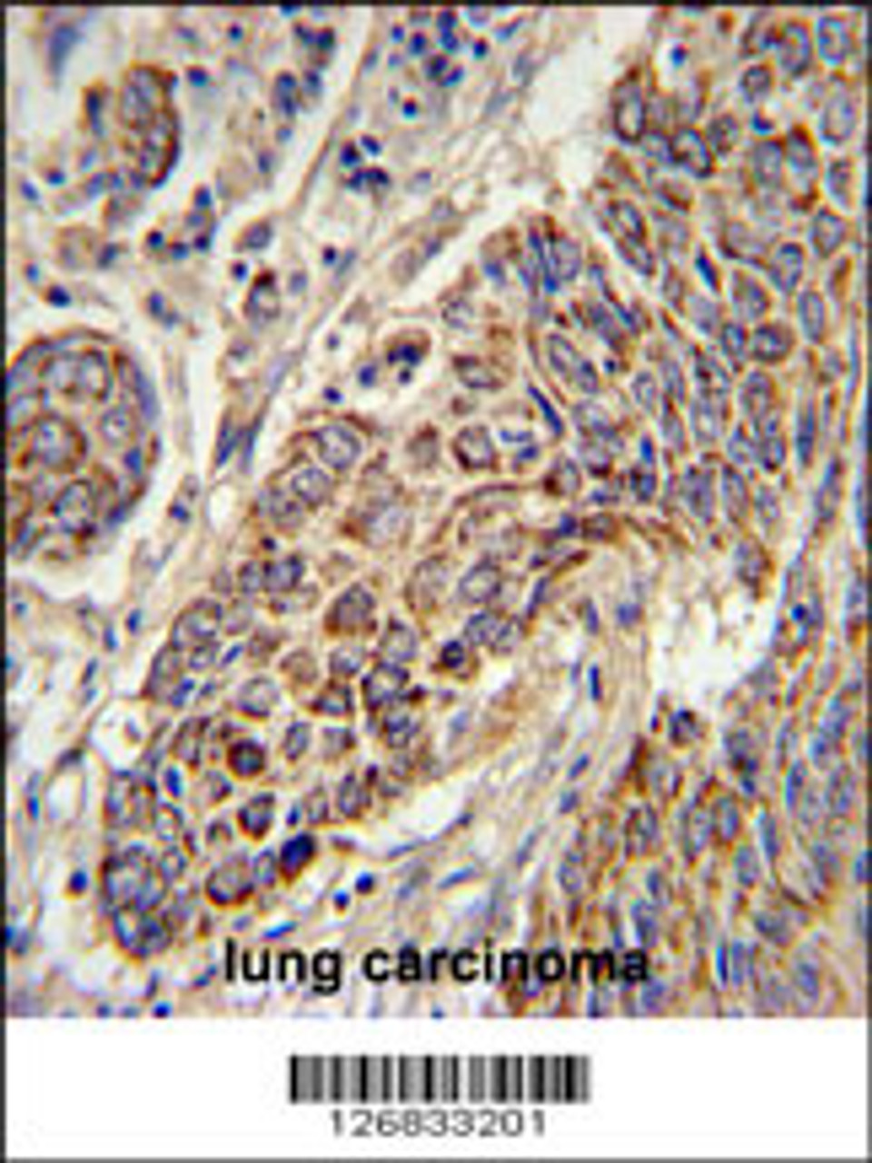 CYC1 Antibody immunohistochemistry analysis in formalin fixed and paraffin embedded human lung carcinoma followed by peroxidase conjugation of the secondary antibody and DAB staining.
