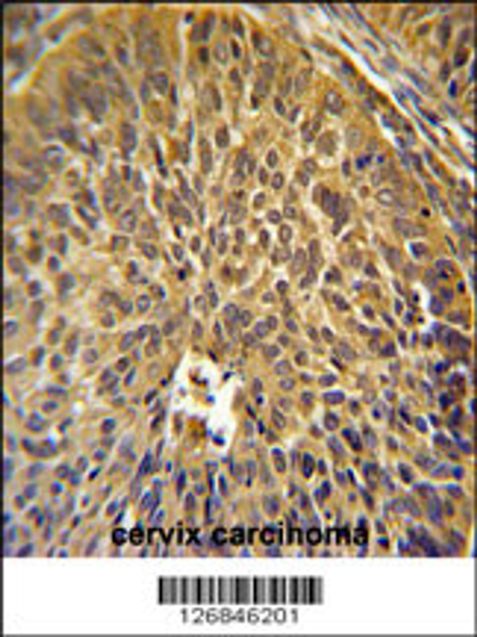 EIF3G Antibody immunohistochemistry analysis in formalin fixed and paraffin embedded human cervix carcinoma followed by peroxidase conjugation of the secondary antibody and DAB staining.