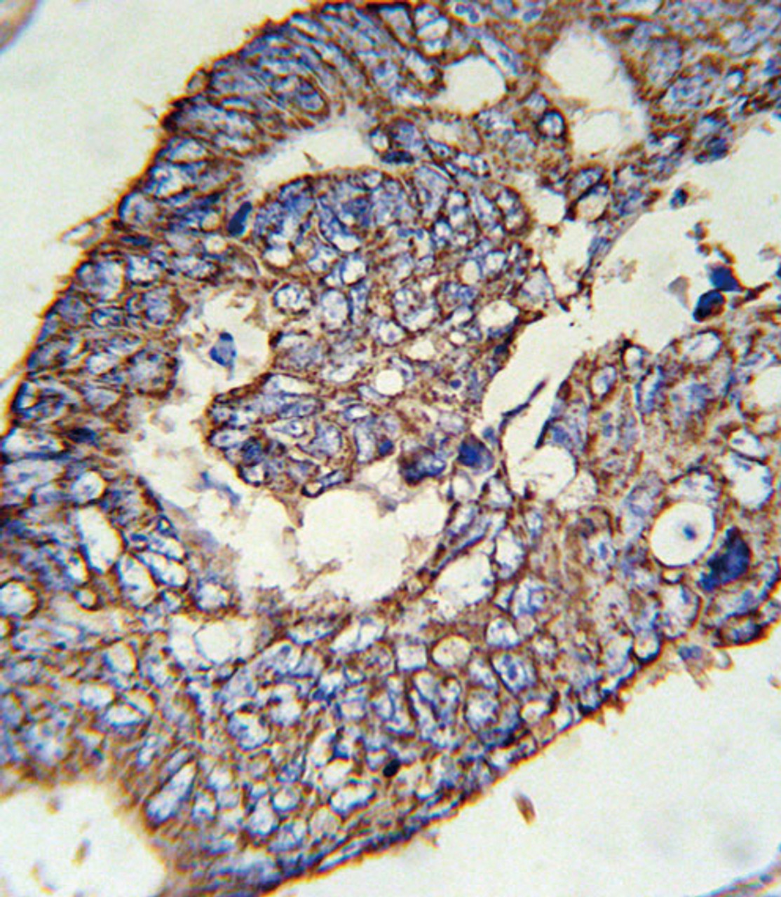 SLC47A1 Antibody immunohistochemistry analysis in formalin fixed and paraffin embedded human colon carcinoma followed by peroxidase conjugation of the secondary antibody and DAB staining.