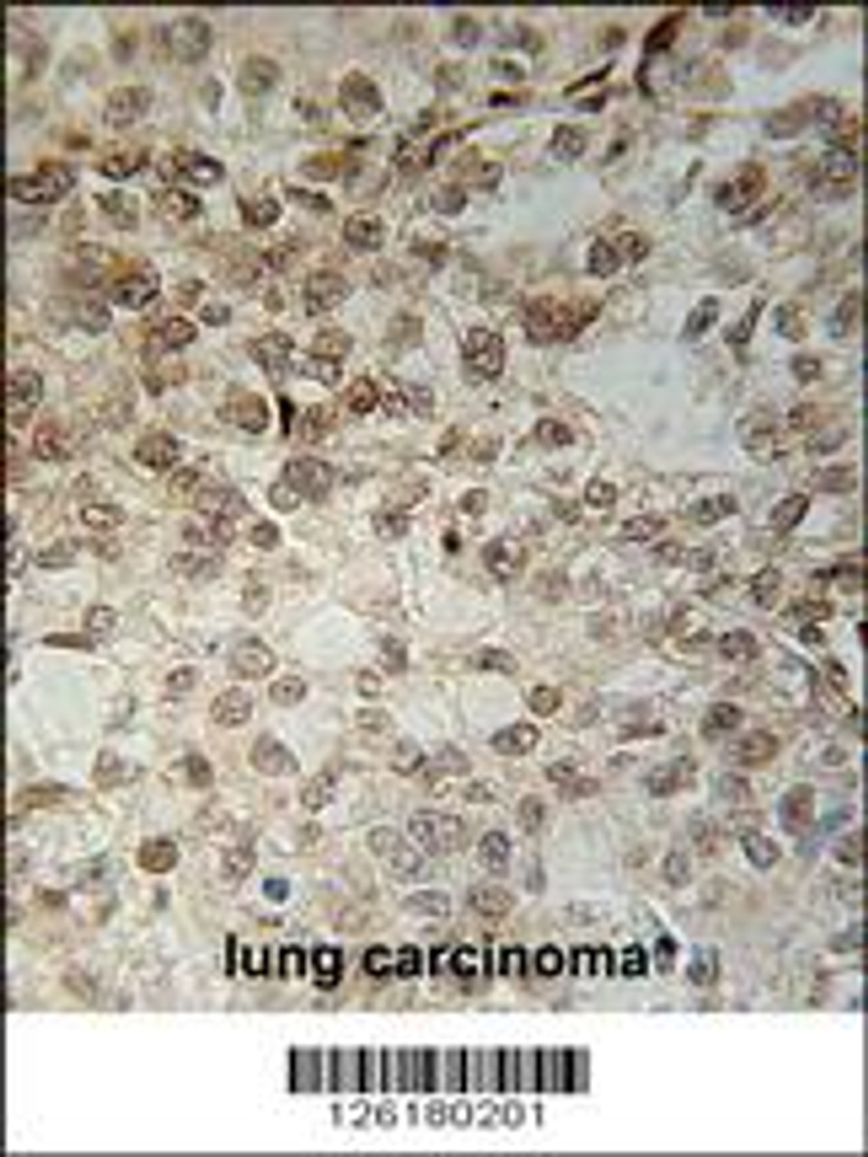 C14orf179 Antibody immunohistochemistry analysis in formalin fixed and paraffin embedded human lung carcinoma followed by peroxidase conjugation of the secondary antibody and DAB staining.