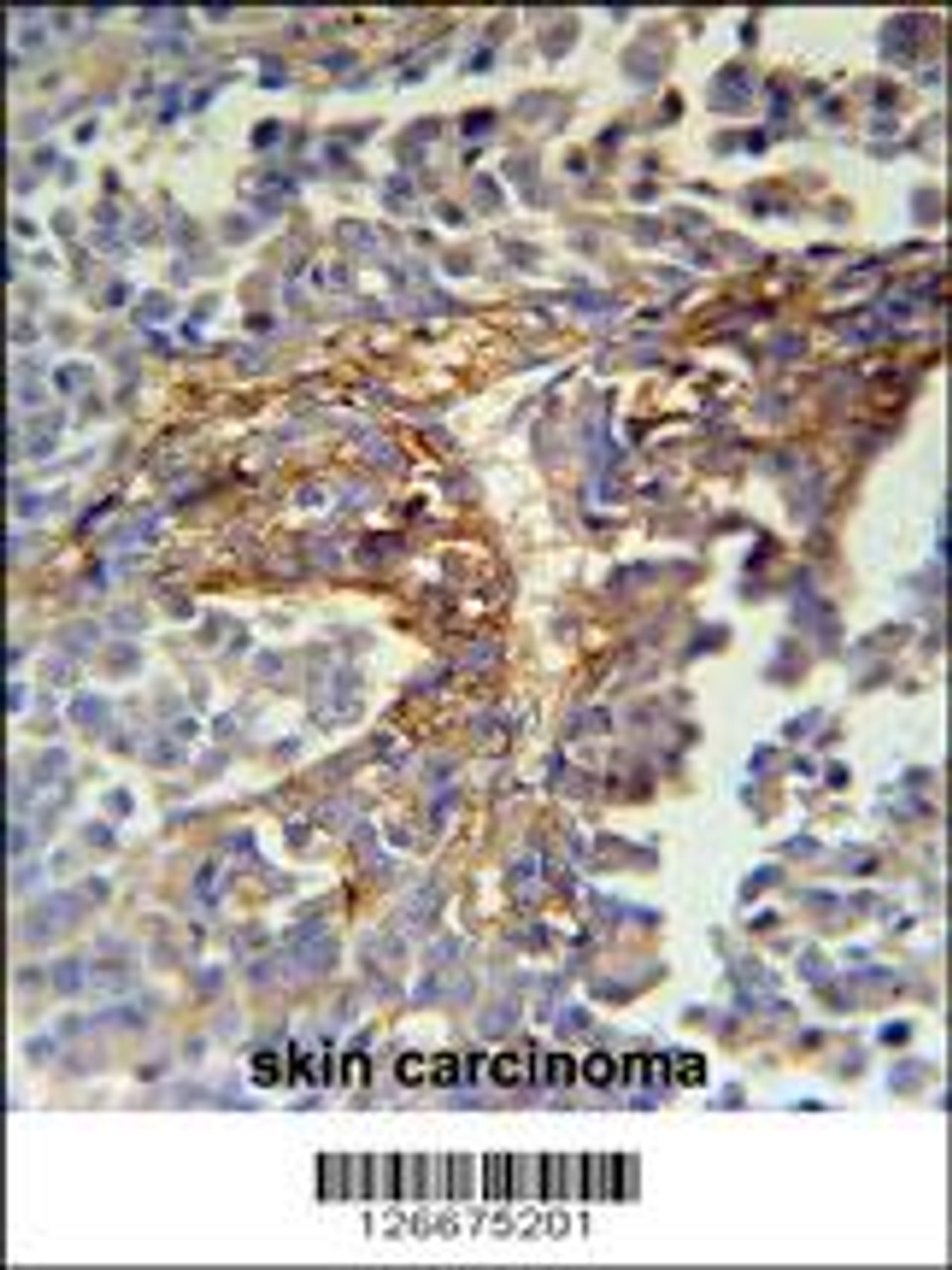 ARMC5 Antibody immunohistochemistry analysis in formalin fixed and paraffin embedded human skin carcinoma followed by peroxidase conjugation of the secondary antibody and DAB staining.