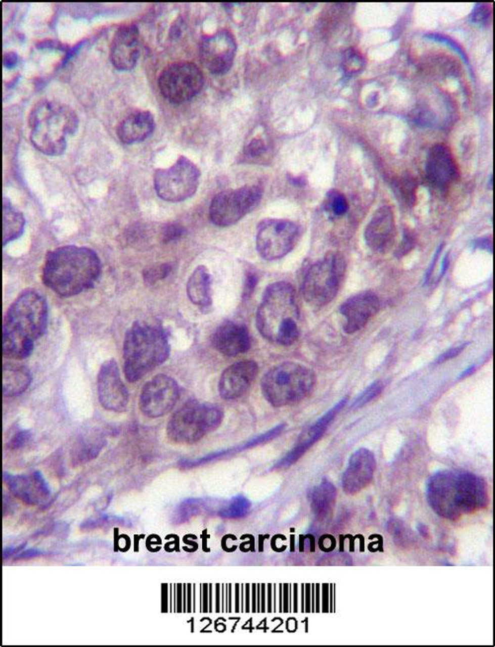 NR3C1 Antibody immunohistochemistry analysis in formalin fixed and paraffin embedded human breast carcinoma followed by peroxidase conjugation of the secondary antibody and DAB staining.