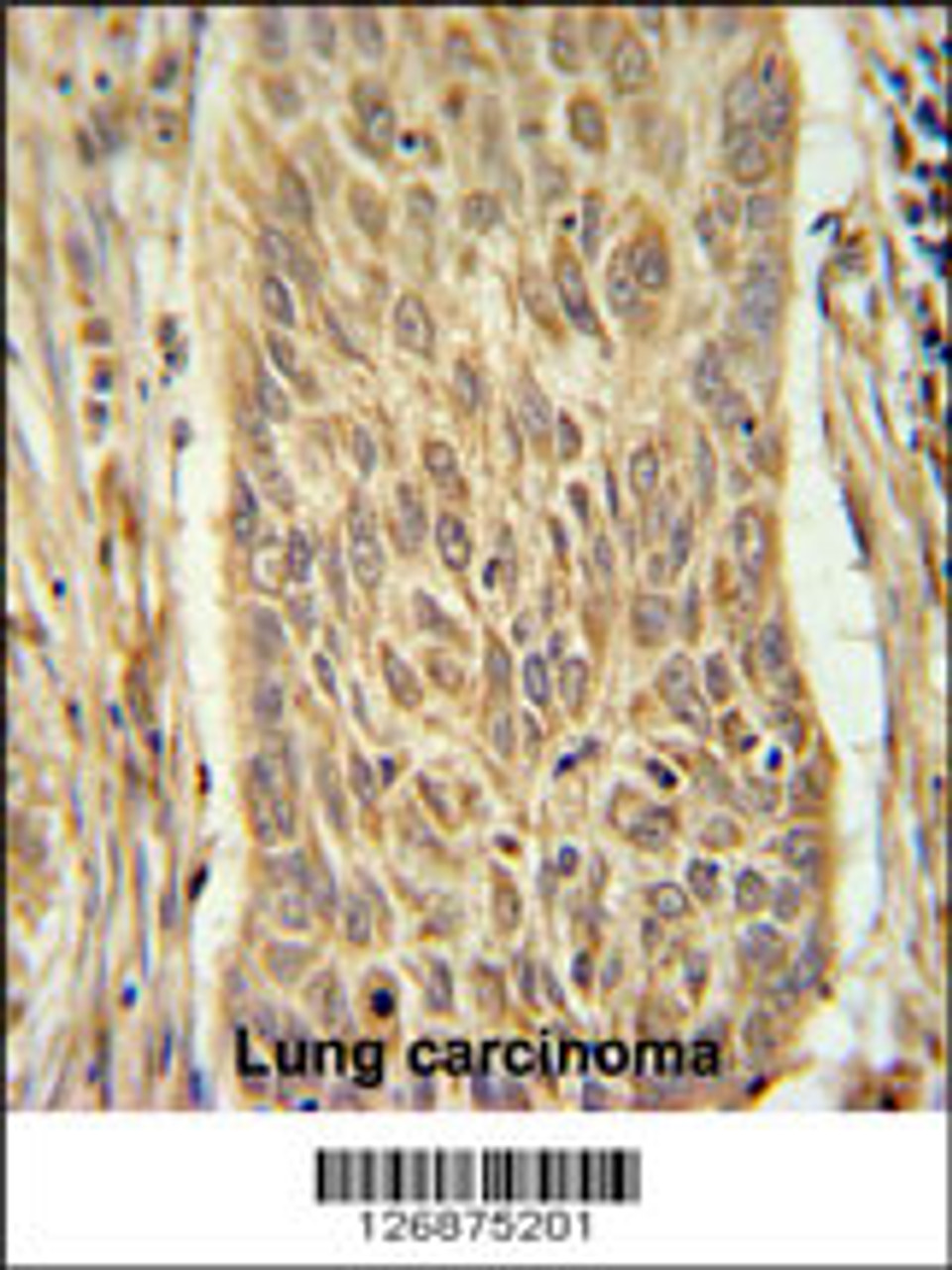 INMT Antibody immunohistochemistry analysis in formalin fixed and paraffin embedded human lung carcinoma followed by peroxidase conjugation of the secondary antibody and DAB staining.