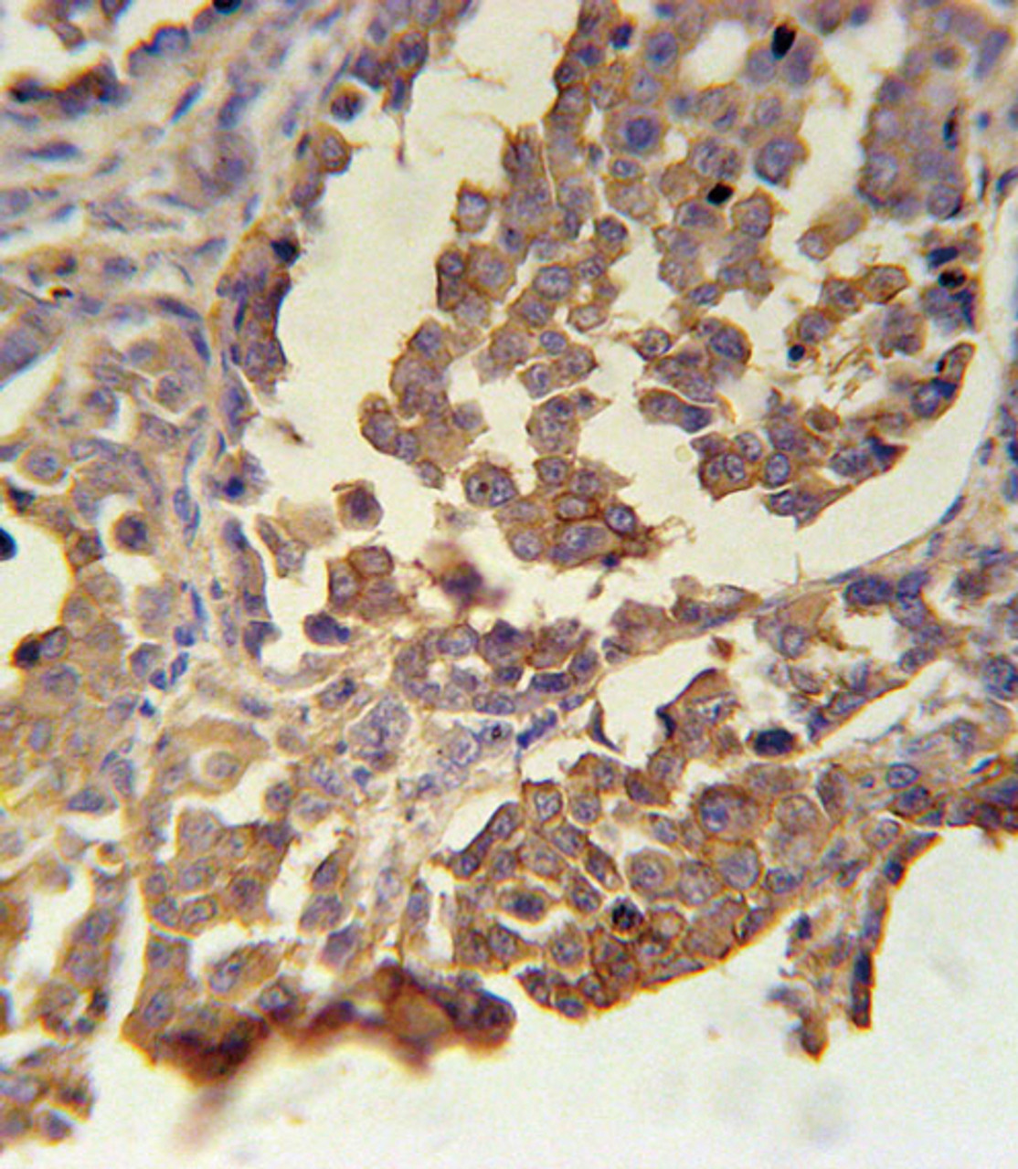 MC2R Antibody immunohistochemistry analysis in formalin fixed and paraffin embedded human skin carcinoma followed by peroxidase conjugation of the secondary antibody and DAB staining.