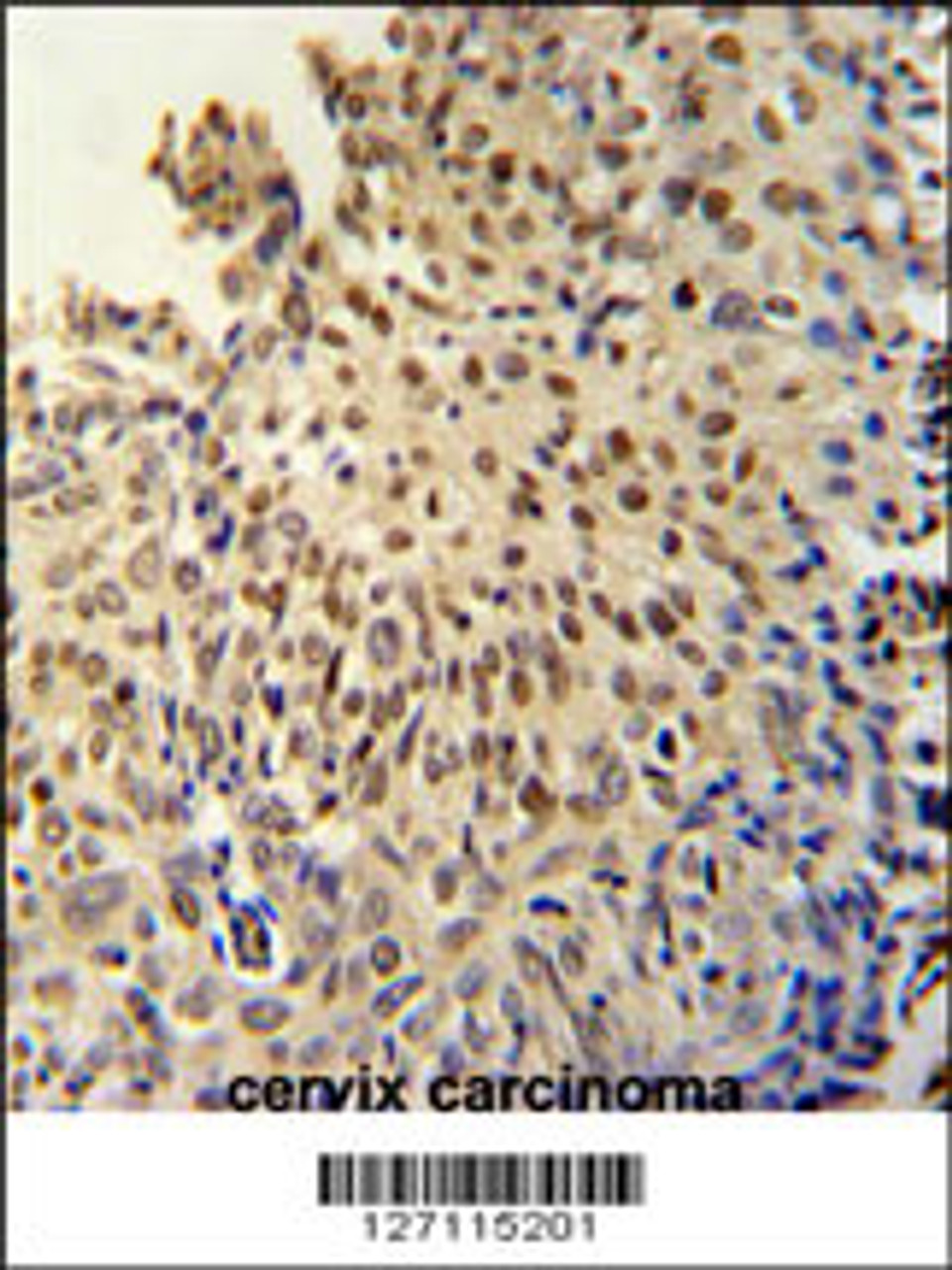 DI3L1 Antibody immunohistochemistry analysis in formalin fixed and paraffin embedded human cervix carcinoma followed by peroxidase conjugation of the secondary antibody and DAB staining.