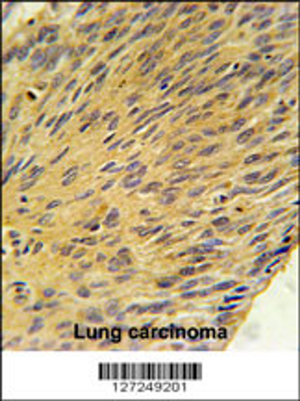 MURC Antibody immunohistochemistry analysis in formalin fixed and paraffin embedded human lung carcinoma followed by peroxidase conjugation of the secondary antibody and DAB staining.