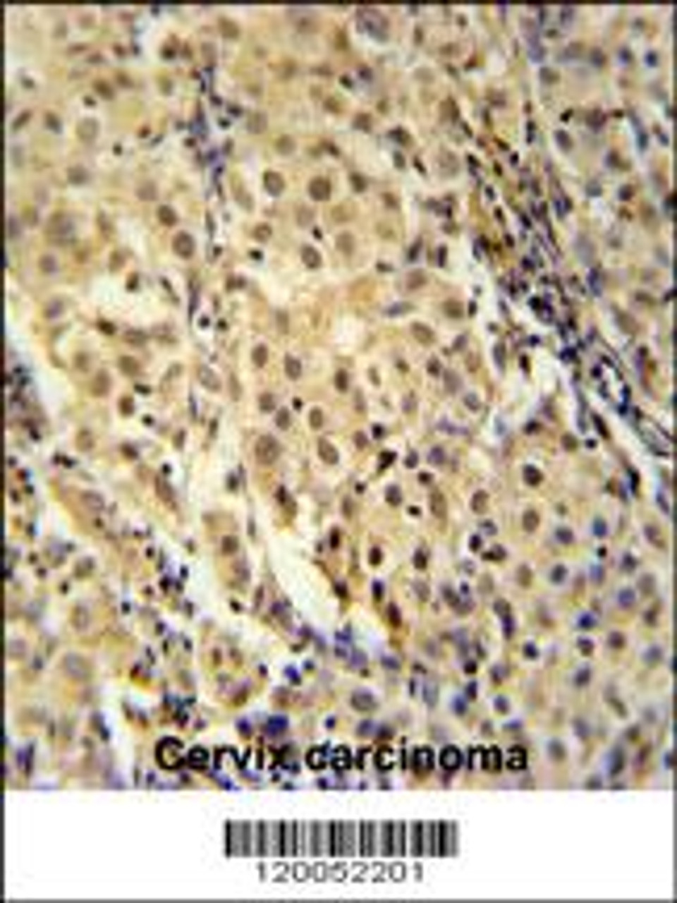 immunohistochemistry analysis in formalin fixed and paraffin embedded human cervix carcinoma followed by peroxidase conjugation of the secondary antibody and DAB staining. This data demonstrates the use of the for immunohistochemistry.