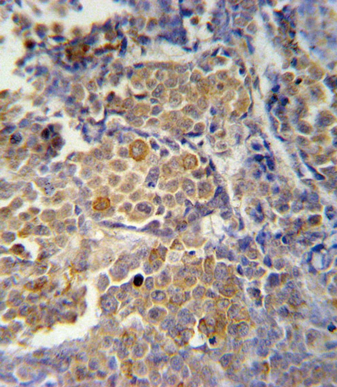 KIR2DS2 Antibody immunohistochemistry analysis in formalin fixed and paraffin embedded human skin carcinoma followed by peroxidase conjugation of the secondary antibody and DAB staining.