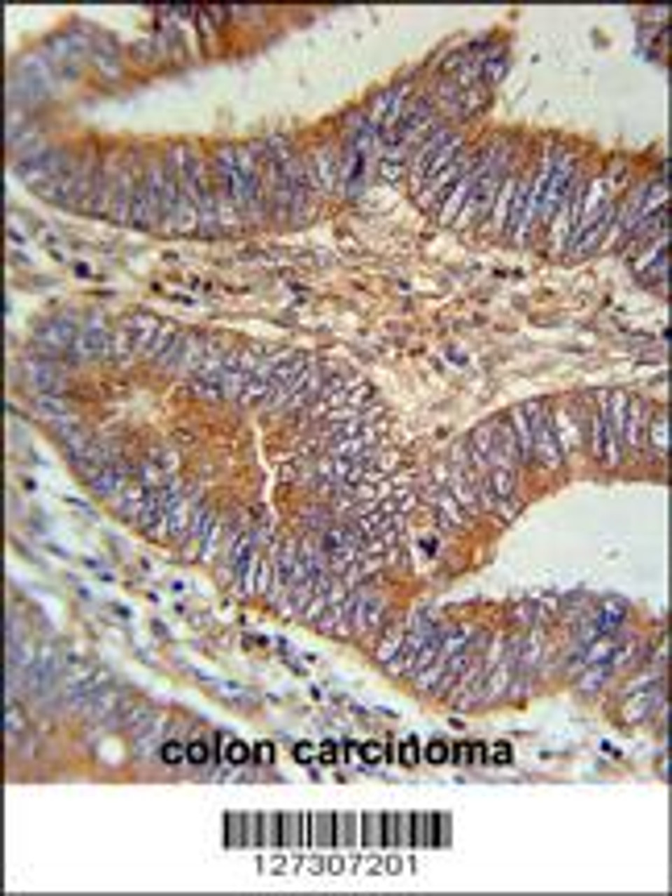 BIN2 Antibody immunohistochemistry analysis in formalin fixed and paraffin embedded human colon carcinoma followed by peroxidase conjugation of the secondary antibody and DAB staining.