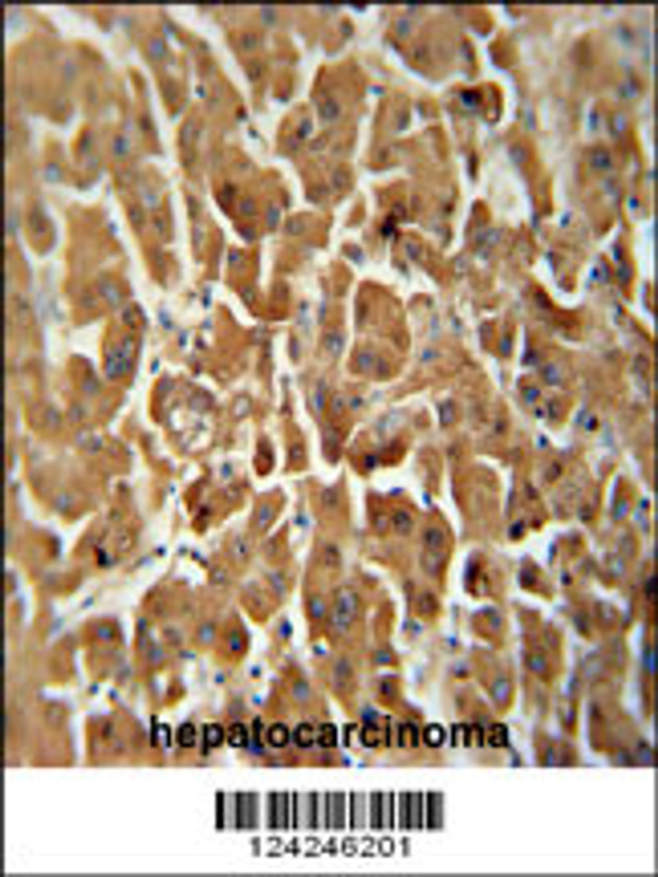 ATP5G2 antibody immunohistochemistry analysis in formalin fixed and paraffin embedded human hepatocarcinoma followed by peroxidase conjugation of the secondary antibody and DAB staining.