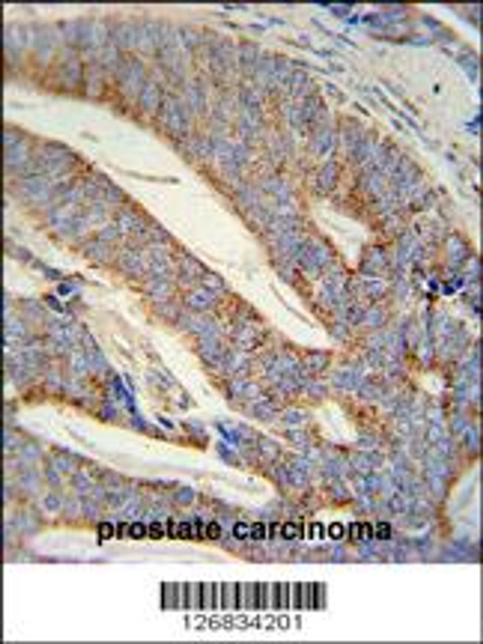 DACT1 antibody immunohistochemistry analysis in formalin fixed and paraffin embedded human prostate carcinoma followed by peroxidase conjugation of the secondary antibody and DAB staining.