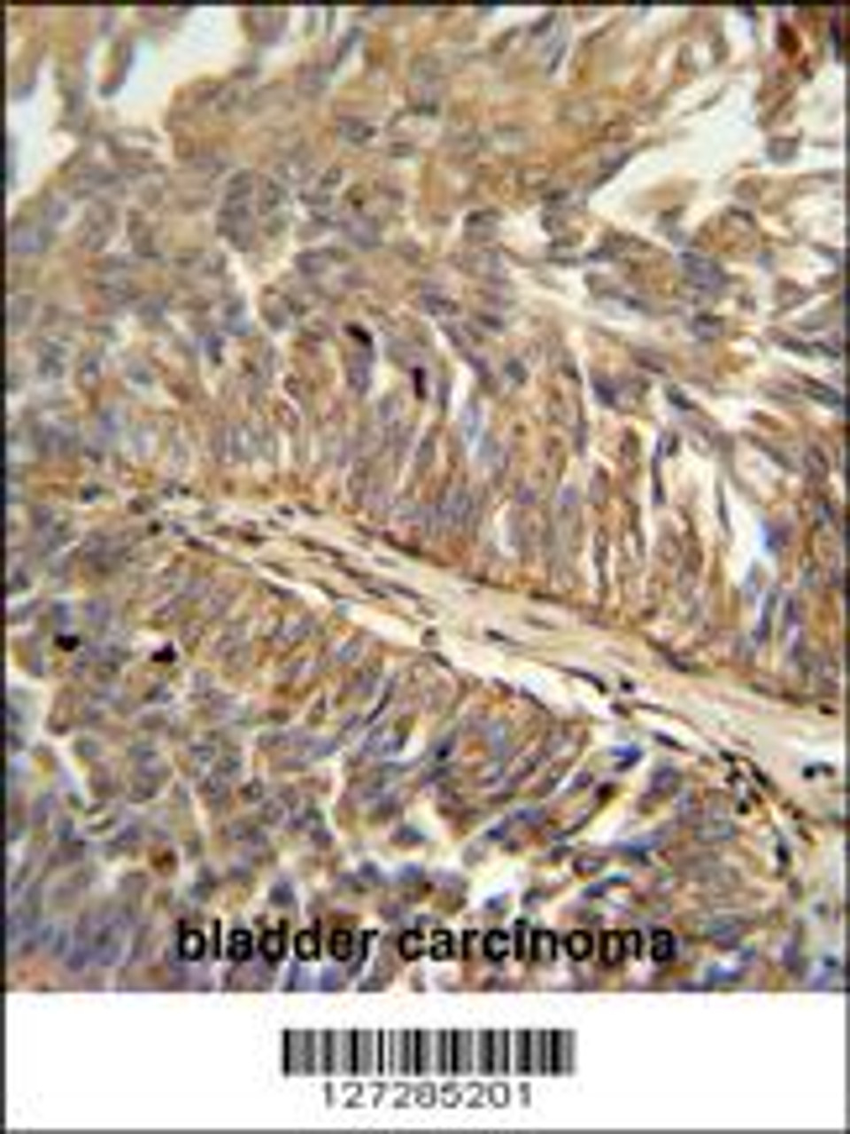 ATP13A3 antibody immunohistochemistry analysis in formalin fixed and paraffin embedded human bladder carcinoma followed by peroxidase conjugation of the secondary antibody and DAB staining.