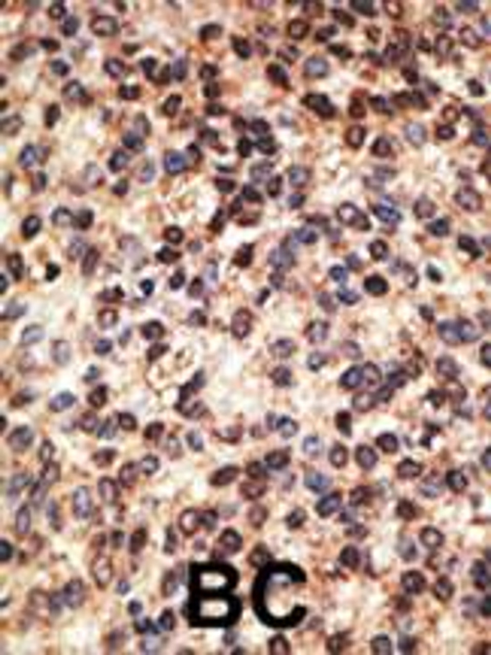 Formalin-fixed and paraffin-embedded human cancer tissue reacted with the primary antibody, which was peroxidase-conjugated to the secondary antibody, followed by DAB staining. BC = breast carcinoma; HC = hepatocarcinoma.