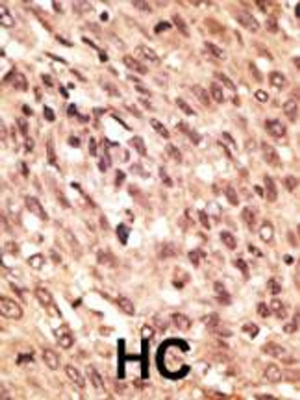 Formalin-fixed and paraffin-embedded human cancer tissue reacted with the primary antibody, which was peroxidase-conjugated to the secondary antibody, followed by AEC staining. BC = breast carcinoma; HC = hepatocarcinoma.