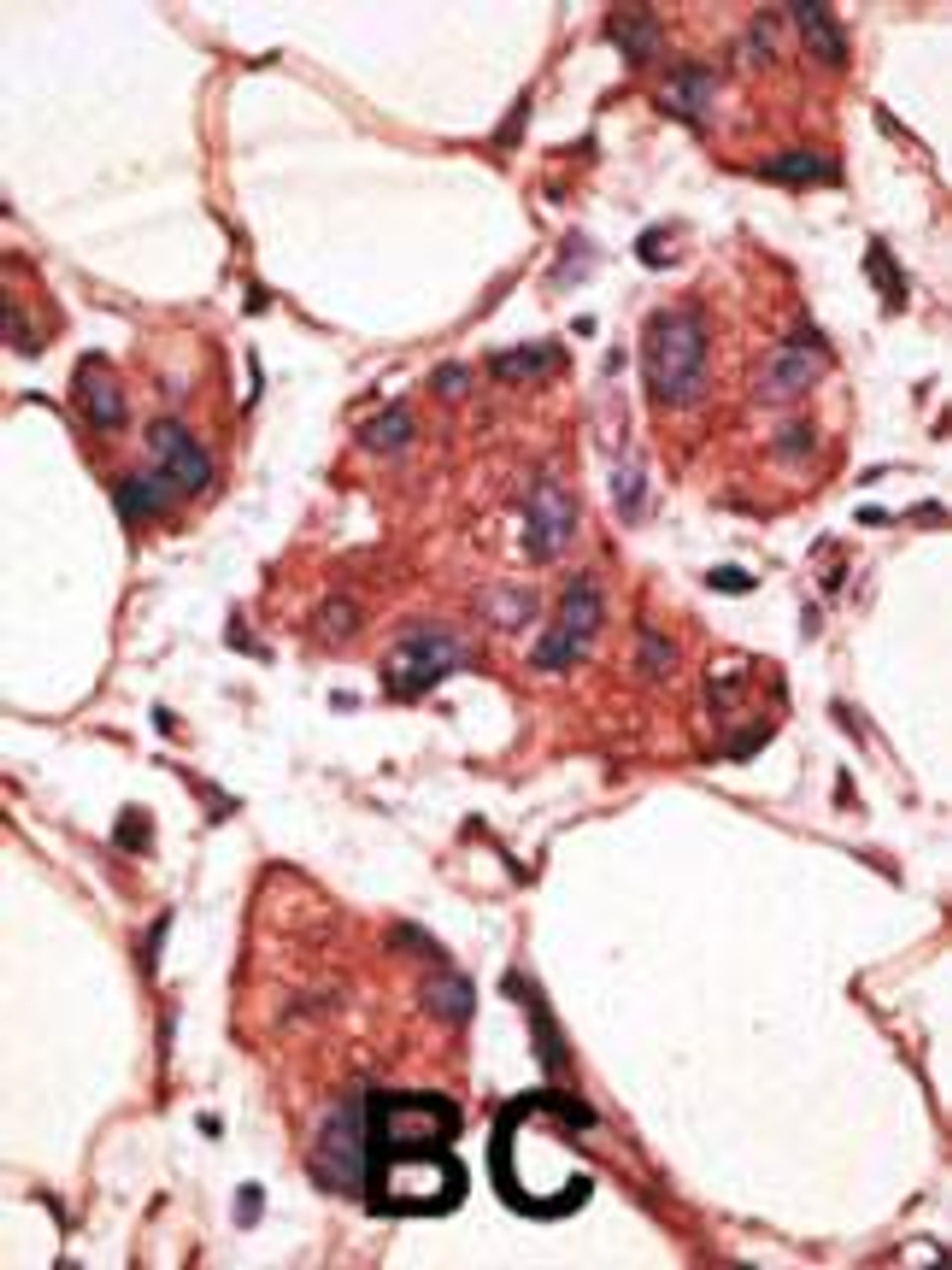 Formalin-fixed and paraffin-embedded human cancer tissue reacted with the primary antibody, which was peroxidase-conjugated to the secondary antibody, followed by AEC staining. BC = breast carcinoma; HC = hepatocarcinoma.