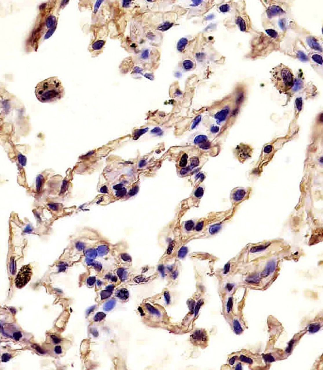 Antibody staining MMP12 in human lung tissue sections by Immunohistochemistry (IHC-P - paraformaldehyde-fixed, paraffin-embedded sections) .