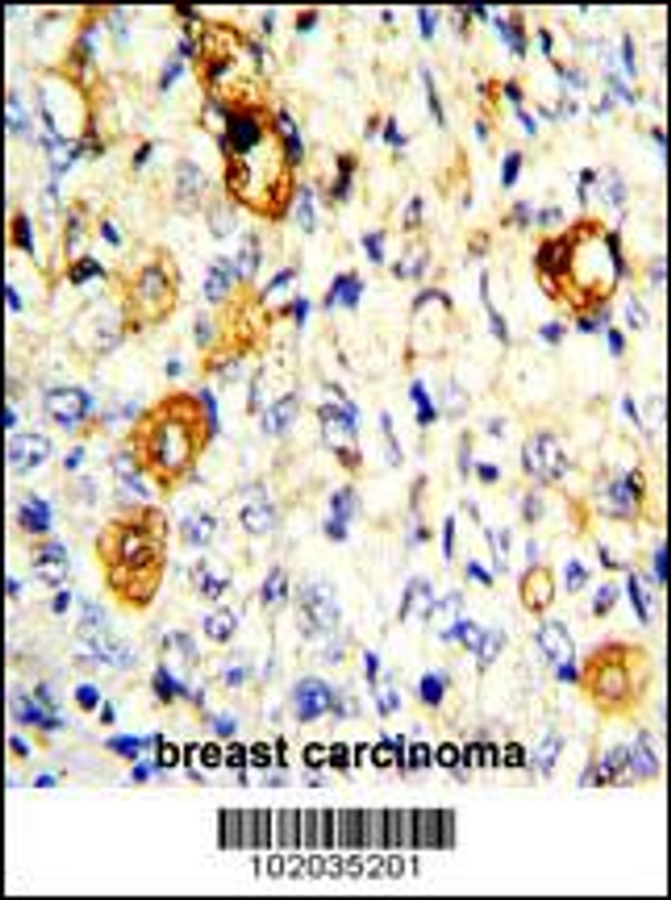 Formalin-fixed and paraffin-embedded human breast carcinoma with MMP19 Antibody, which was peroxidase-conjugated to the secondary antibody, followed by DAB staining.