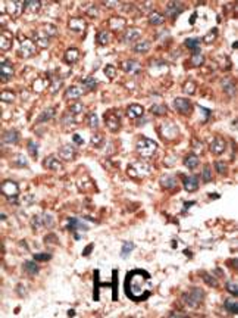 Formalin-fixed and paraffin-embedded human cancer tissue reacted with the primary antibody, which was peroxidase-conjugated to the secondary antibody, followed by DAB staining. BC = breast carcinoma; HC = hepatocarcinoma.