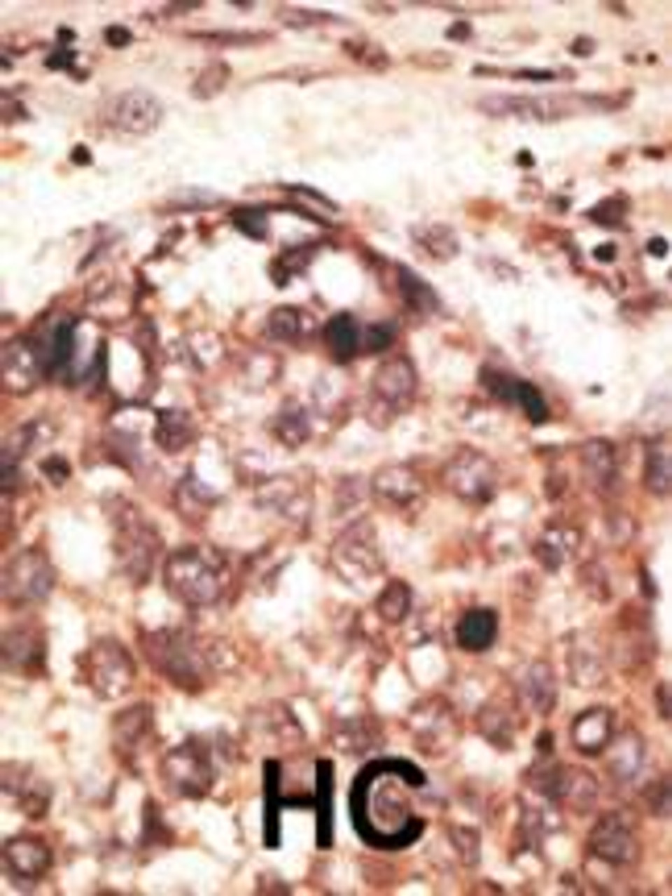 Formalin-fixed and paraffin-embedded human cancer tissue reacted with the primary antibody, which was peroxidase-conjugated to the secondary antibody, followed by AEC staining. BC = breast carcinoma; HC = hepatocarcinoma.