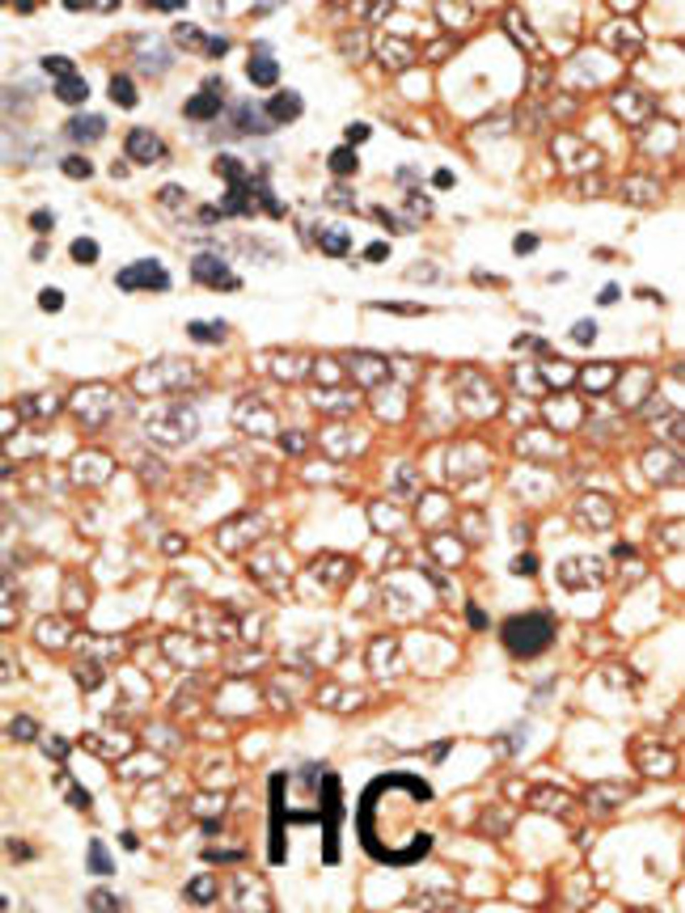 Formalin-fixed and paraffin-embedded human cancer tissue reacted with the primary antibody, which was peroxidase-conjugated to the secondary antibody, followed by AEC staining. BC = breast carcinoma; HC = hepatocarcinoma.