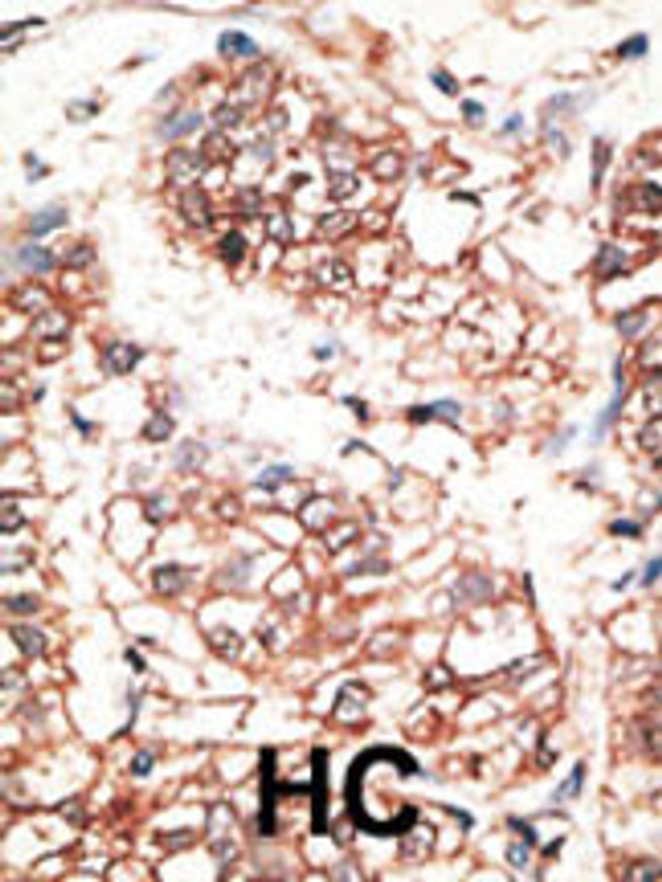 Formalin-fixed and paraffin-embedded human cancer tissue reacted with the primary antibody, which was peroxidase-conjugated to the secondary antibody, followed by AEC staining. BC = breast carcinoma; HC = hepatocarcinoma.