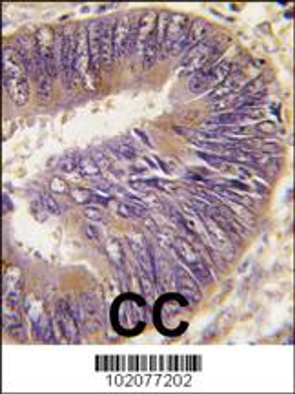 Formalin-fixed and paraffin-embedded human colon carcinoma tissue reacted with ST13 antibody (N-term) , which was peroxidase-conjugated to the secondary antibody, followed by DAB staining.