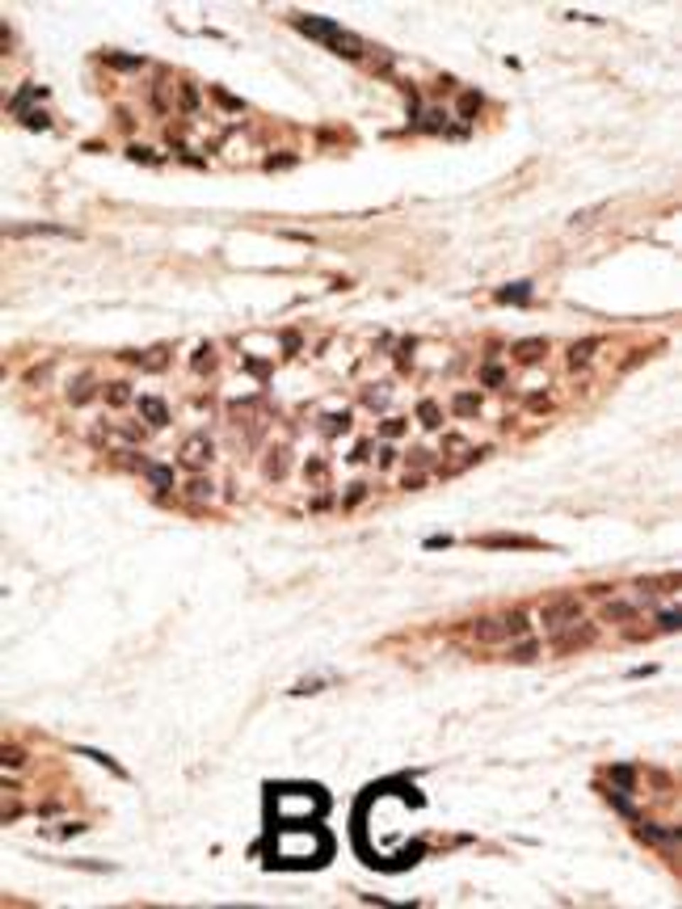 Formalin-fixed and paraffin-embedded human cancer tissue reacted with the primary antibody, which was peroxidase-conjugated to the secondary antibody, followed by AEC staining. BC = breast carcinoma; HC = hepatocarcinoma.